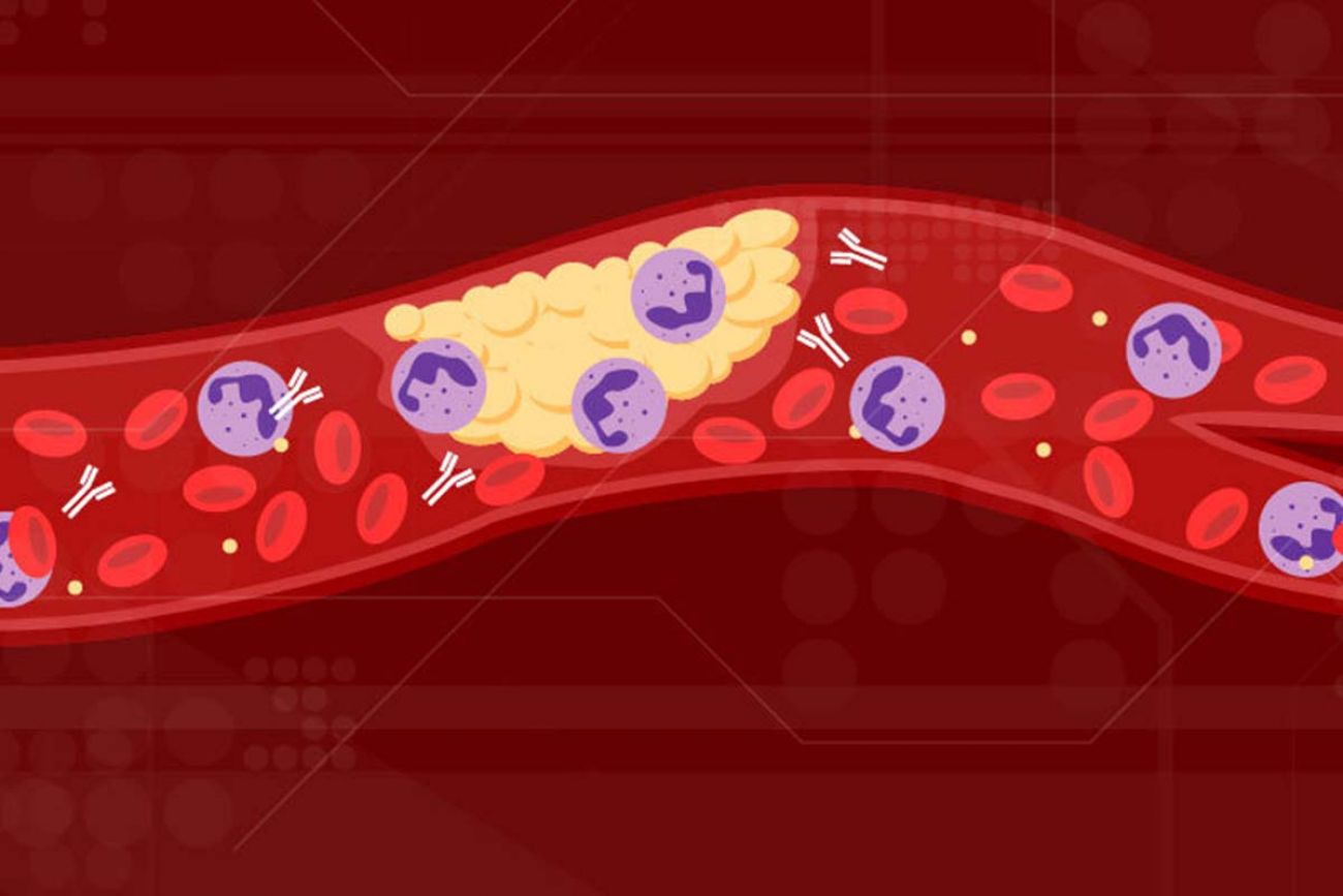 University of Michigan team links 'rogue' antibodies to COVID blood clots