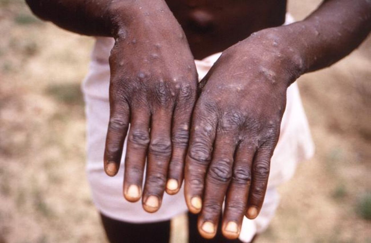 Monkeypox in multiple countries– call for caution, not alarm