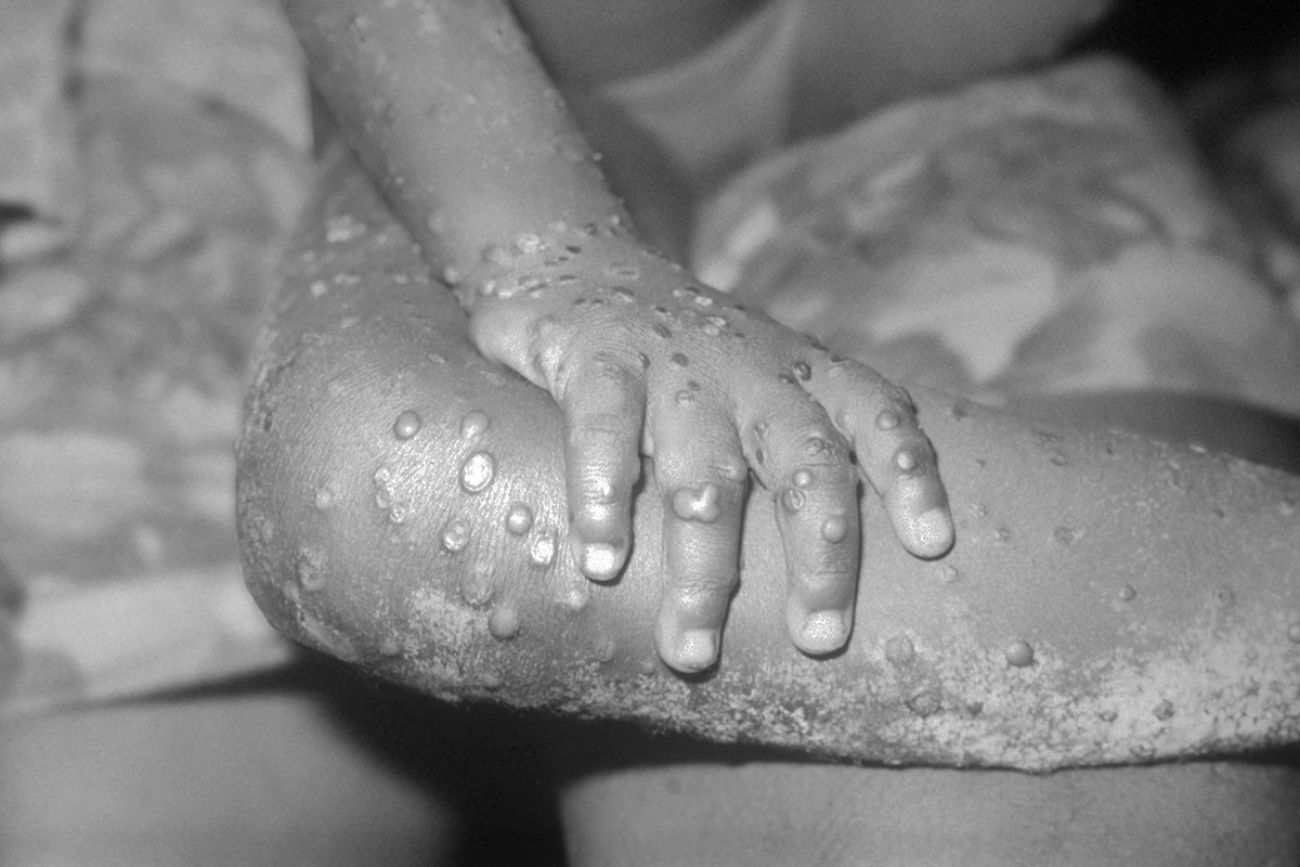 child with monkeypox