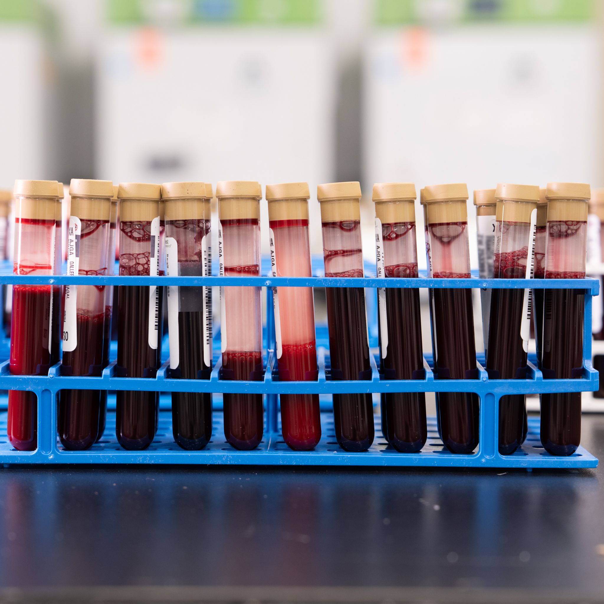Blood test can find cancers, save Michigan lives. Is that worth $100B? - Bridge Michigan